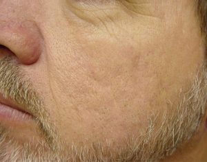 LaserGenesis_acne_after