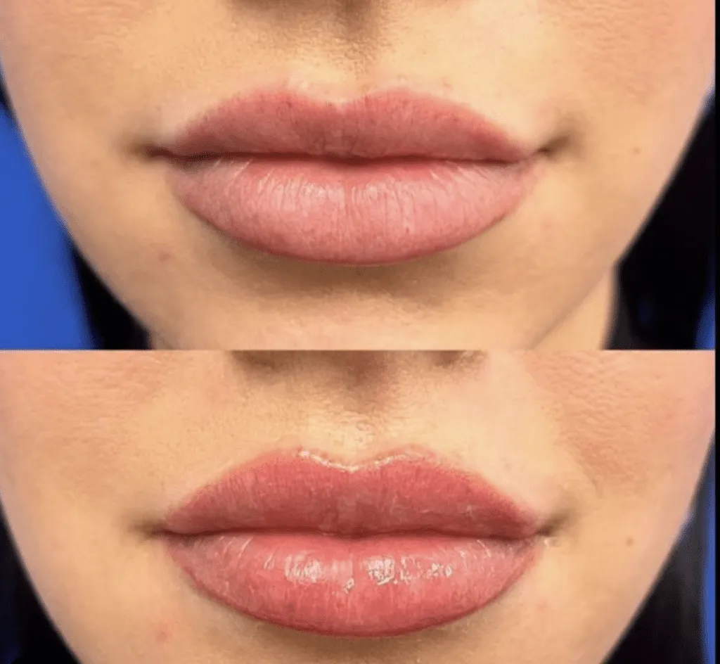 Unveiling the Power of LipLase and Cheek Fillers