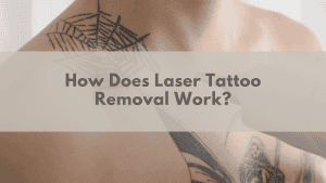 How Does Laser Tattoo Removal Work? | Plexus South Yarra
