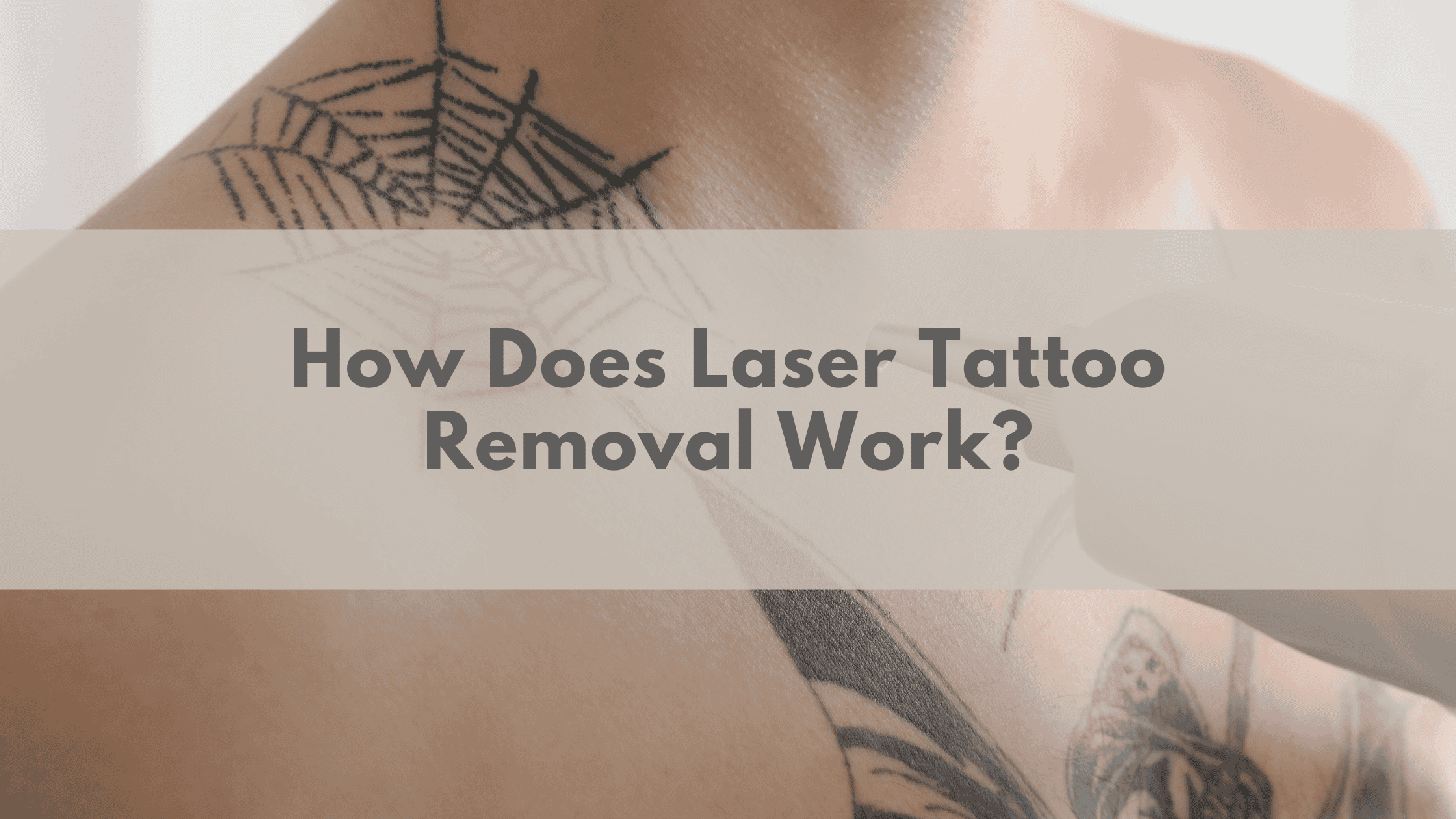 How Does Laser Tattoo Removal Work?