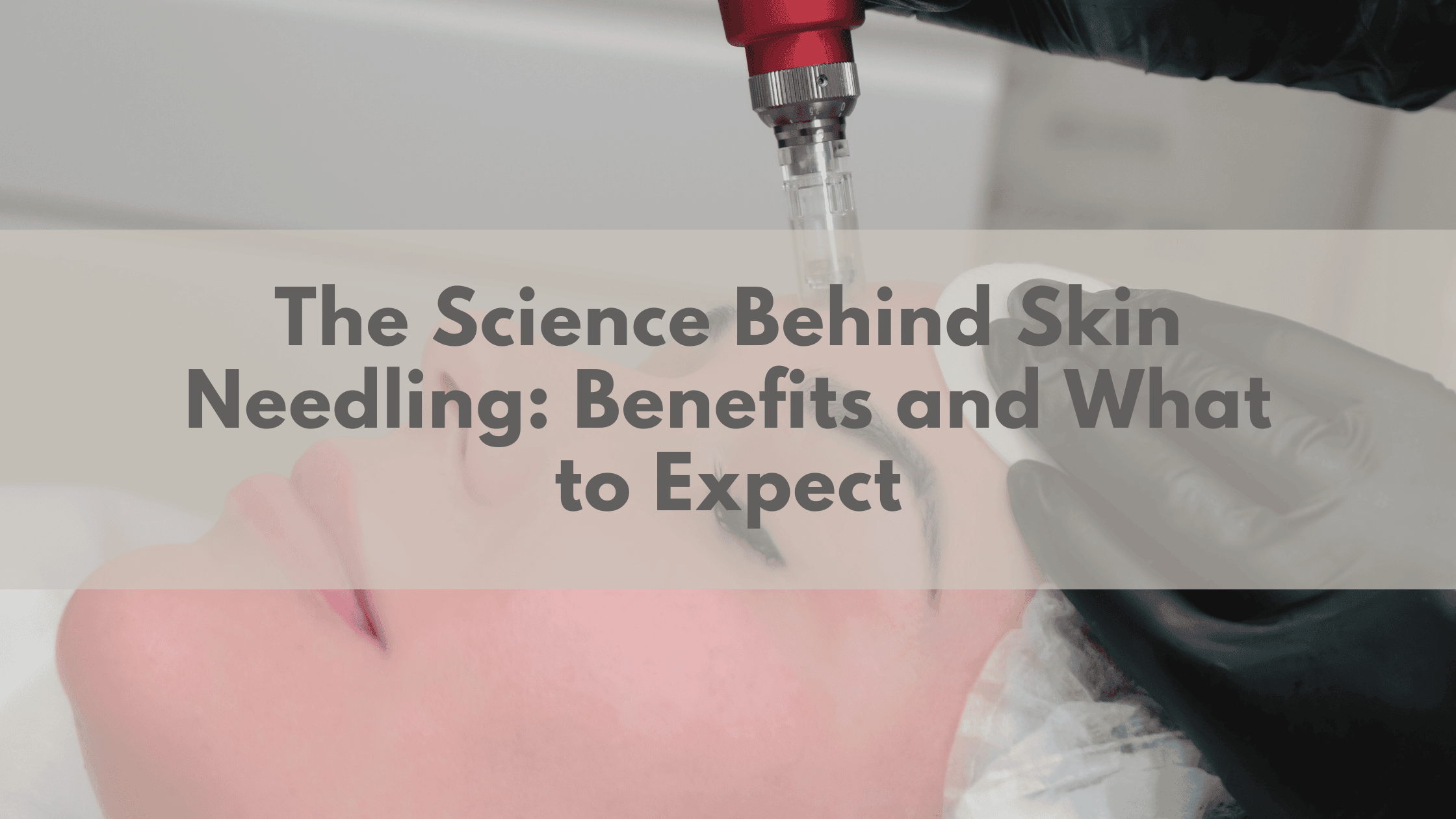 The Science Behind Skin Needling: Benefits and What to Expect | Plexus South Yarra
